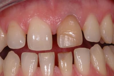 Début eclaircissement nqirkv - Eugenol