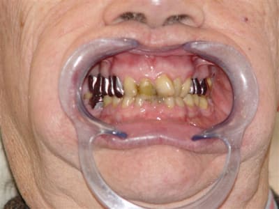 Début traitement wfea6c - Eugenol