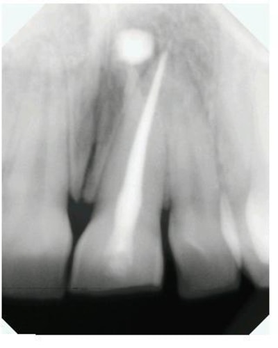 Dépassement 21 jymtjh - Eugenol