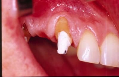 Dépose wtn2zr - Eugenol