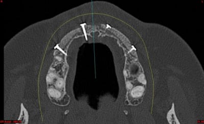 Dar axial lebnbu - Eugenol