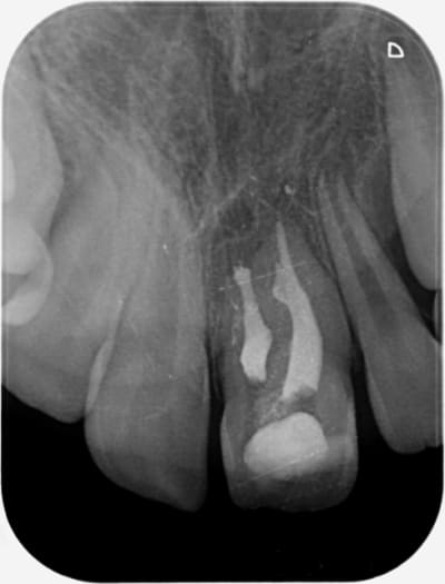 Dens in dente 21 nx3dhm - Eugenol