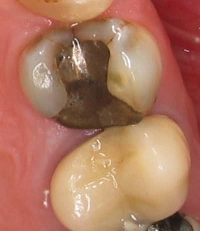 Dent 14 q8ky0k - Eugenol