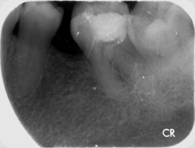 Dent vivante 2 m7b7nh - Eugenol