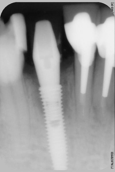 Dentium eii pglogv - Eugenol
