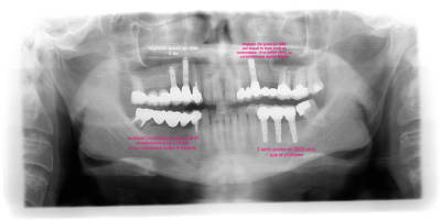 Dentoimplantoport  lds9mp - Eugenol