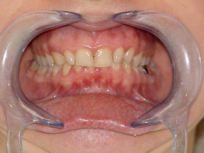 Dentosophie isa occlusion début j0jcjy - Eugenol