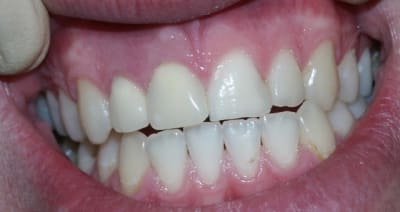 Dentpro coegnn - Eugenol