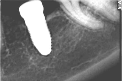 Douieb ocuriq - Eugenol
