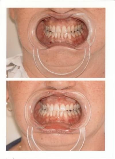 Eclaircissement ou dentosophie d7ttj1 - Eugenol