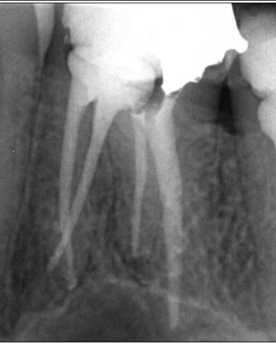 Endo 10  2  fin xxakkc - Eugenol