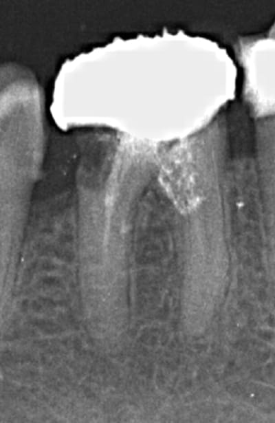 Endo 14  1  preop rl6qb9 - Eugenol