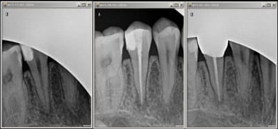Endo 25 t0nzhp - Eugenol