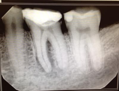 Endo 36   pre op kldksv - Eugenol