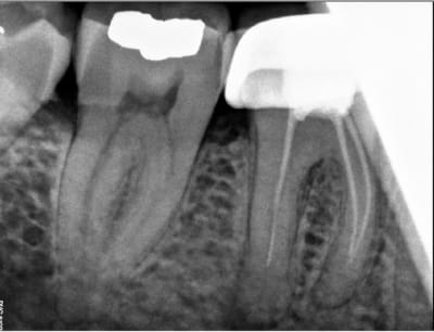 Endo   couronne angleterre nhs x42tsh - Eugenol