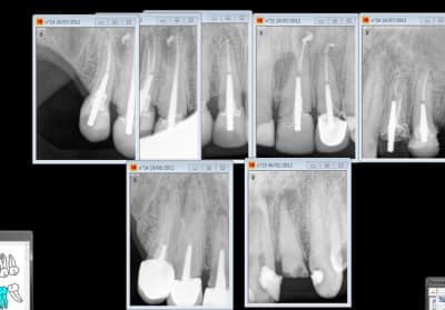 Endo depose reprise ou traitement initial ms9v2z - Eugenol