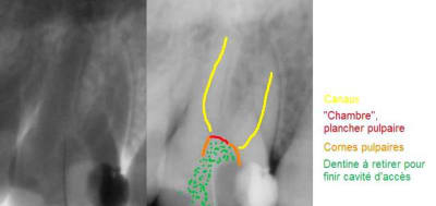 Endo hi5ocv - Eugenol