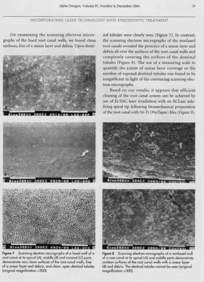 Endo laser yjxuzn - Eugenol