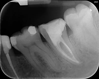 Endo pspix rtonyn - Eugenol