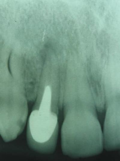 Endo ratée 3 df5tai - Eugenol