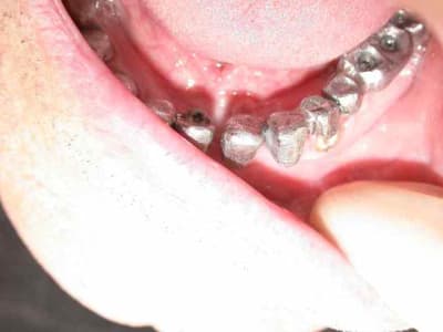 Essai armature ez9ddl - Eugenol