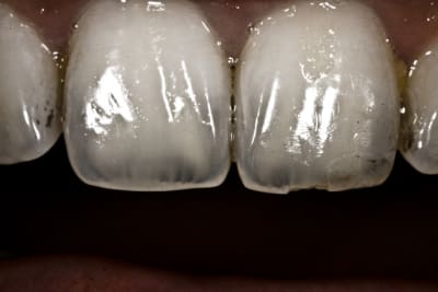 Essai photo dentaire 011b tssjfd - Eugenol