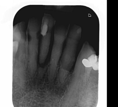 Everstick1 jes8c5 - Eugenol