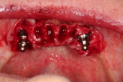 Extraction implantation iquifl - Eugenol