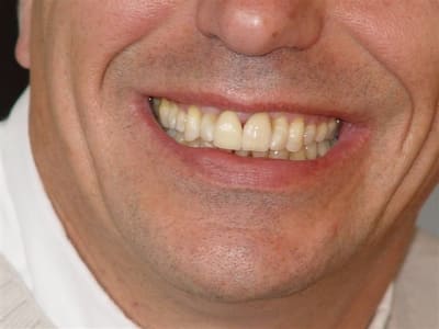 Facettes procera p3zsyx - Eugenol