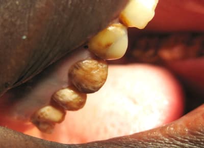 Fluorose002 kltvgr - Eugenol