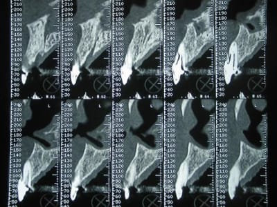 Fracture2 uwmnj0 - Eugenol