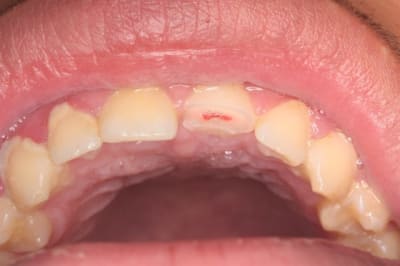 Fracture 21  800x600  dmhs5n - Eugenol