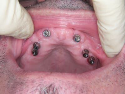 Fracture app resine 3mois post mci avec coiffes telescopes rpefabriqu s  1  hwzgsy - Eugenol