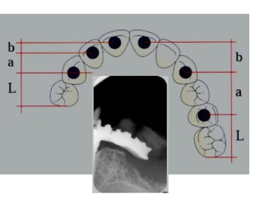 Fracture jvgnu7 - Eugenol