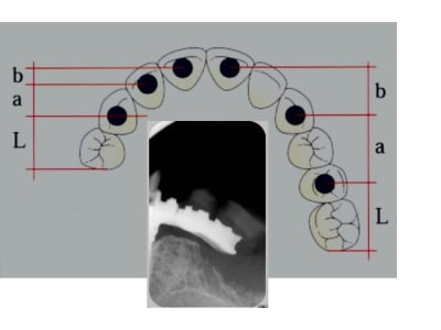 Fracture r2rpii - Eugenol