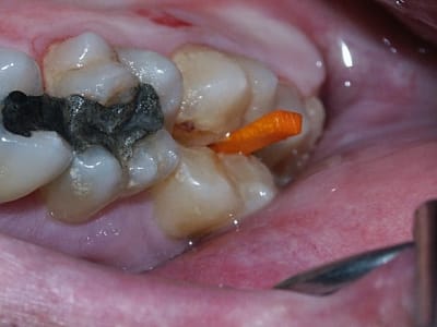 Fracture wnhjxv - Eugenol