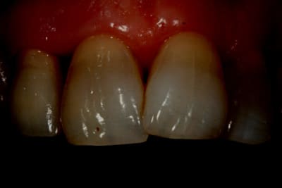 G apr s 4 dentsedit sfumrn - Eugenol