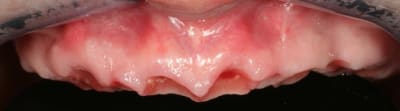 Gencive vgfsaz - Eugenol