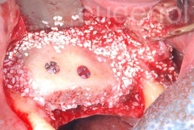 Greffe gauche iarplz - Eugenol