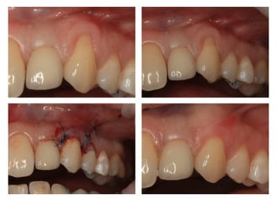 Greffe tissu 23 idzs0b - Eugenol