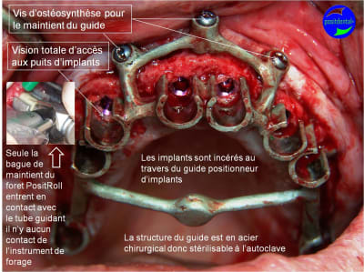 Guide chirurgical positionneur d implants pour mise en charge immédiate o539ws - Eugenol