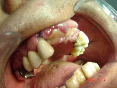 Images cliniques 002 gaqsbd - Eugenol