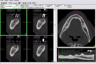 Implant11mm copie tprs6t - Eugenol