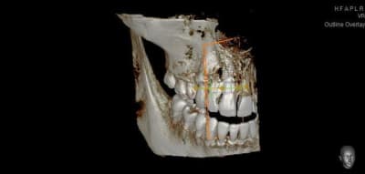 Implant 12 nj49qr - Eugenol