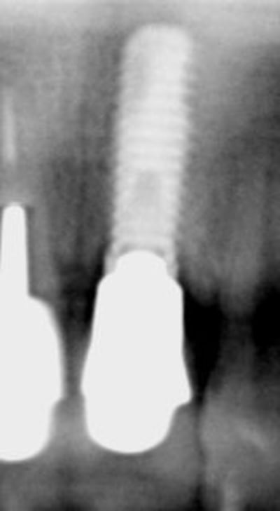 Implant 21 suite xrzmdx - Eugenol