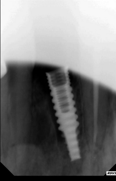 Implant 22 wcm7yr - Eugenol