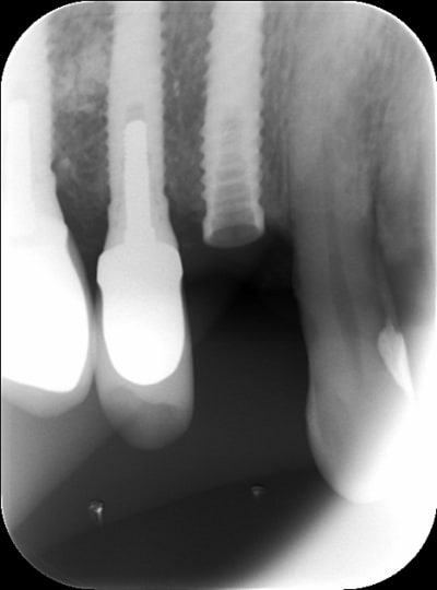 Implant 6229 20110712 17 00 06 gd5qdi - Eugenol