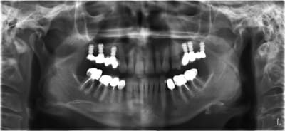 Implant court d7htxi - Eugenol