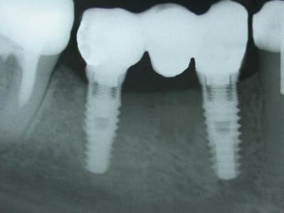 Implant dflhs3 - Eugenol