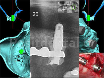 Implant en 26 nrxgxi - Eugenol